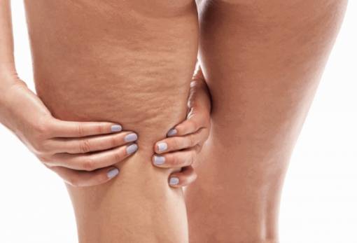 Πως θα περιορίσεις την κυτταρίτιδα εν όψει καλοκαιριού