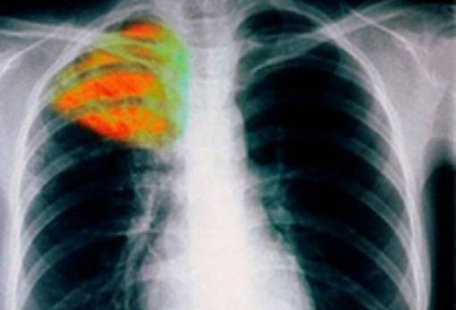 Καμπανάκι για την φυματίωση από τον Εθνικό Οργανισμό Δημόσιας Υγείας