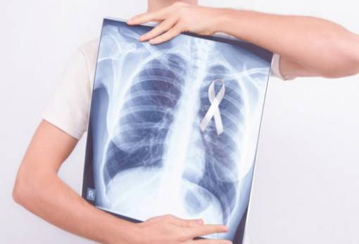 Καρκίνος του πνεύμονα: Γιατί το 41% των ασθενών διαγιγνώσκονται σε προχωρημένο στάδιο