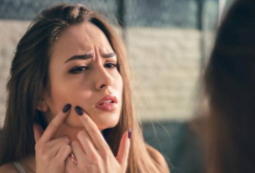 4 τοπικές θεραπείες για να αντιμετωπίσεις την ακμή