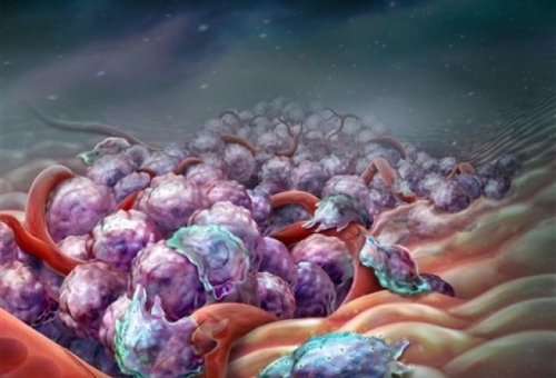 Πειραματική θεραπεία «φρενάρει» τη μετάσταση του καρκίνου